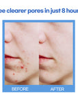 Acne Patch Shapes (Daily) | 72 Patches | Infused with Tea Tree Oil