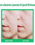 Acne Patch Shapes (Holiday) | 85 Patches | Infused with Tea Tree Oil