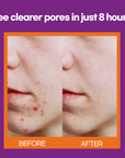 Acne Patch Shapes (Halloween) | 75 Patches | Infused with Tea Tree Oil