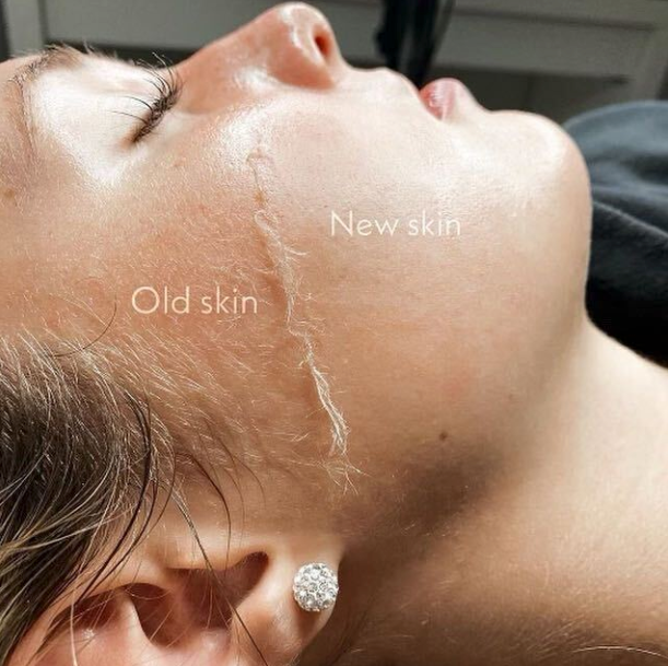 before & after dermaplane